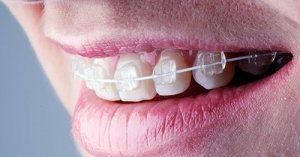 Ortodontia de Excelência em Ribeirão Preto