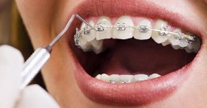 Aparelho Ortodôntico: Guia Completo para um Sorriso Perfeito