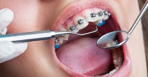 A Importância das Consultas Regulares ao Dentista Durante o Tratamento com Aparelho Ortodôntico